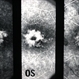 Benign Concentric Macular Annular Dystrophy